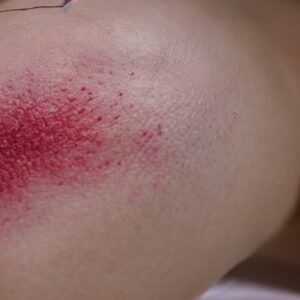 can-sunscreen-cause-a-prickly-heat-rash