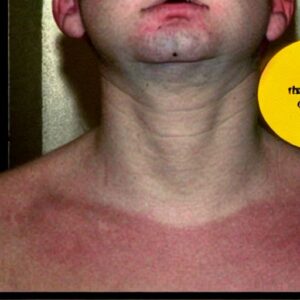can-sunscreen-cause-a-prickly-heat-rash